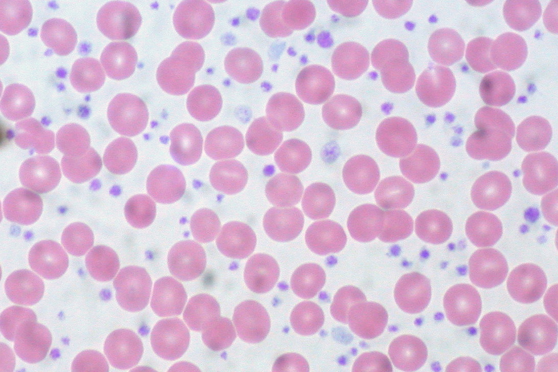 This represents a platelet count between 1.5 and 2 million per microliter (normal range is between 0.150 and 0.450 million). The patient had had an elevated count for at least 15 years but is asymptomatic.[6]