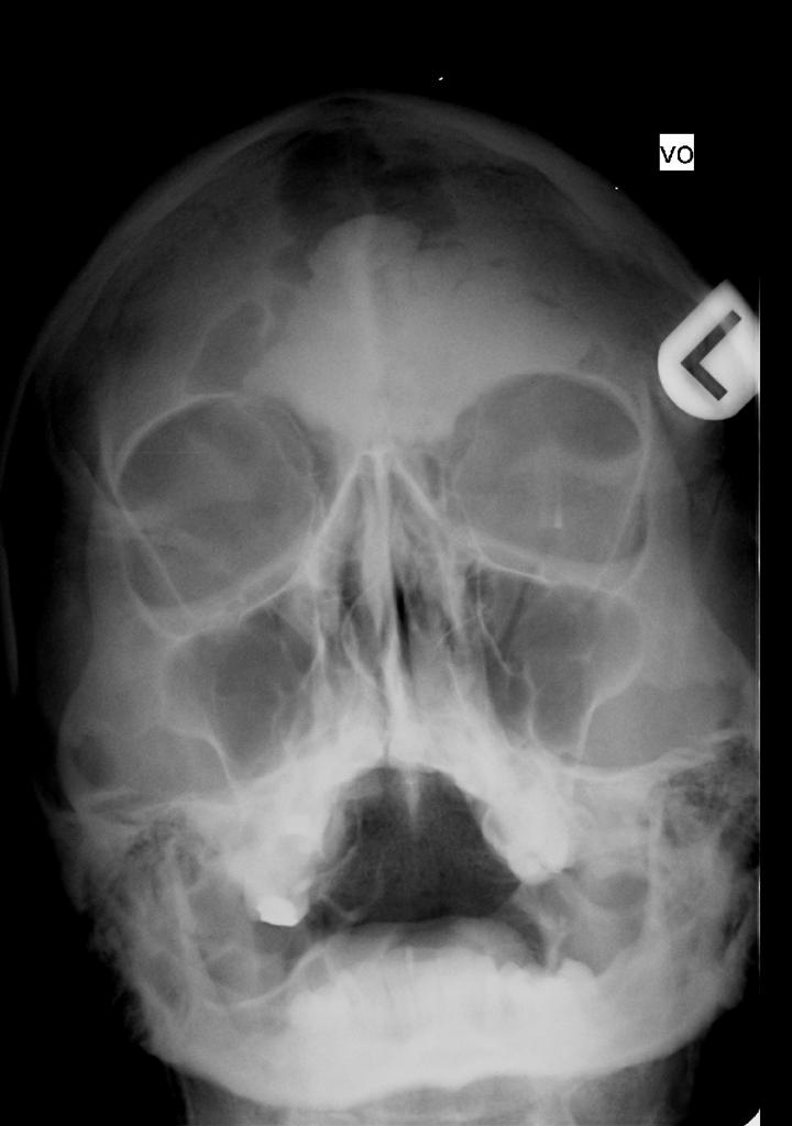 Frontal giant sinus osteoma (waters view). Courtesy of Radiopedia.[1]