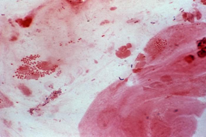 Photomicrograph of Neisseria gonorrhoeae in cervical smear using the Gram-stain technique. From Public Health Image Library (PHIL). [6]