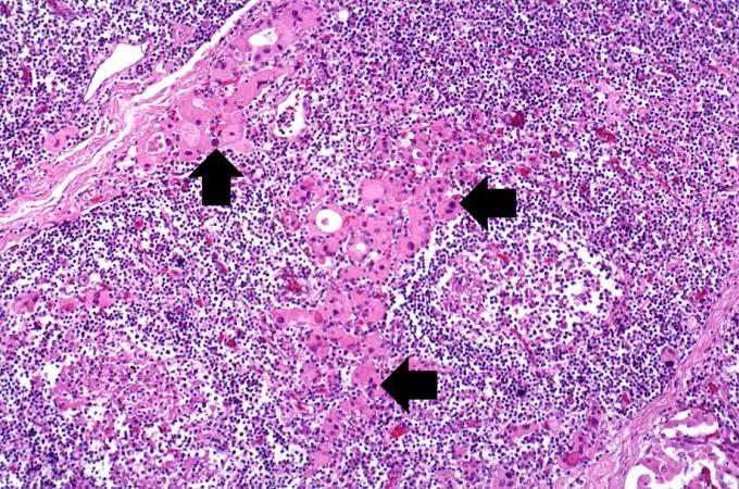 This high-power photomicrograph shows more clearly the lymphocytes and plasma cells surrounding the thyroid gland epithelium. Large, eosinophilic, degenerating thyroid gland cells (Hurthle cells) can be seen in this section (arrows).
