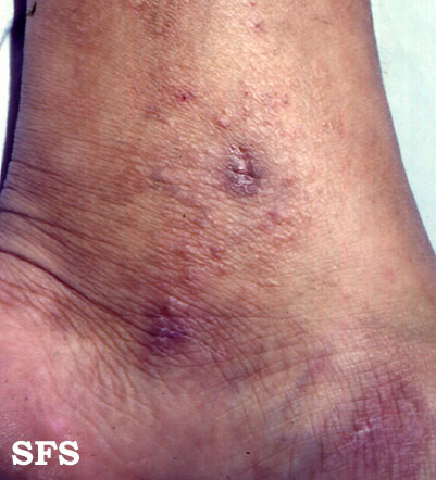 File:Vasculitis leukocytoclasia 04.jpeg