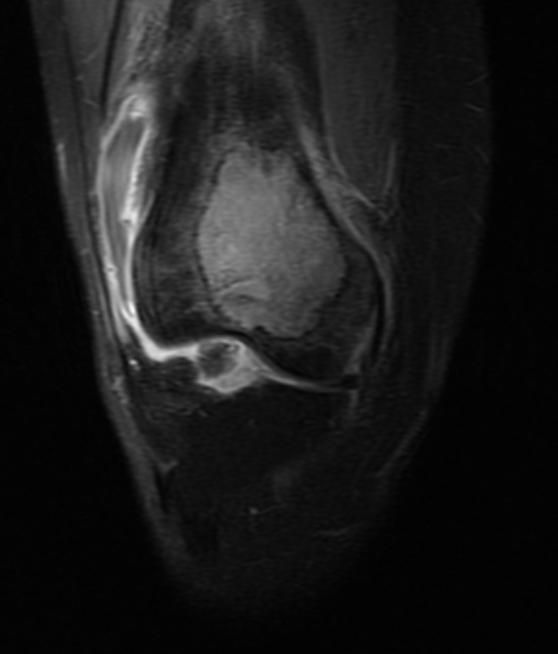 Giant cell tumor: Distal part of the femur