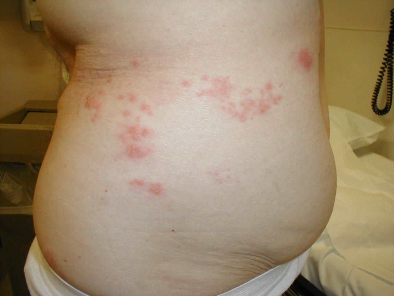 Herpes Zoster: Dermatomally distributed vesicles in patient with HZV infection.
