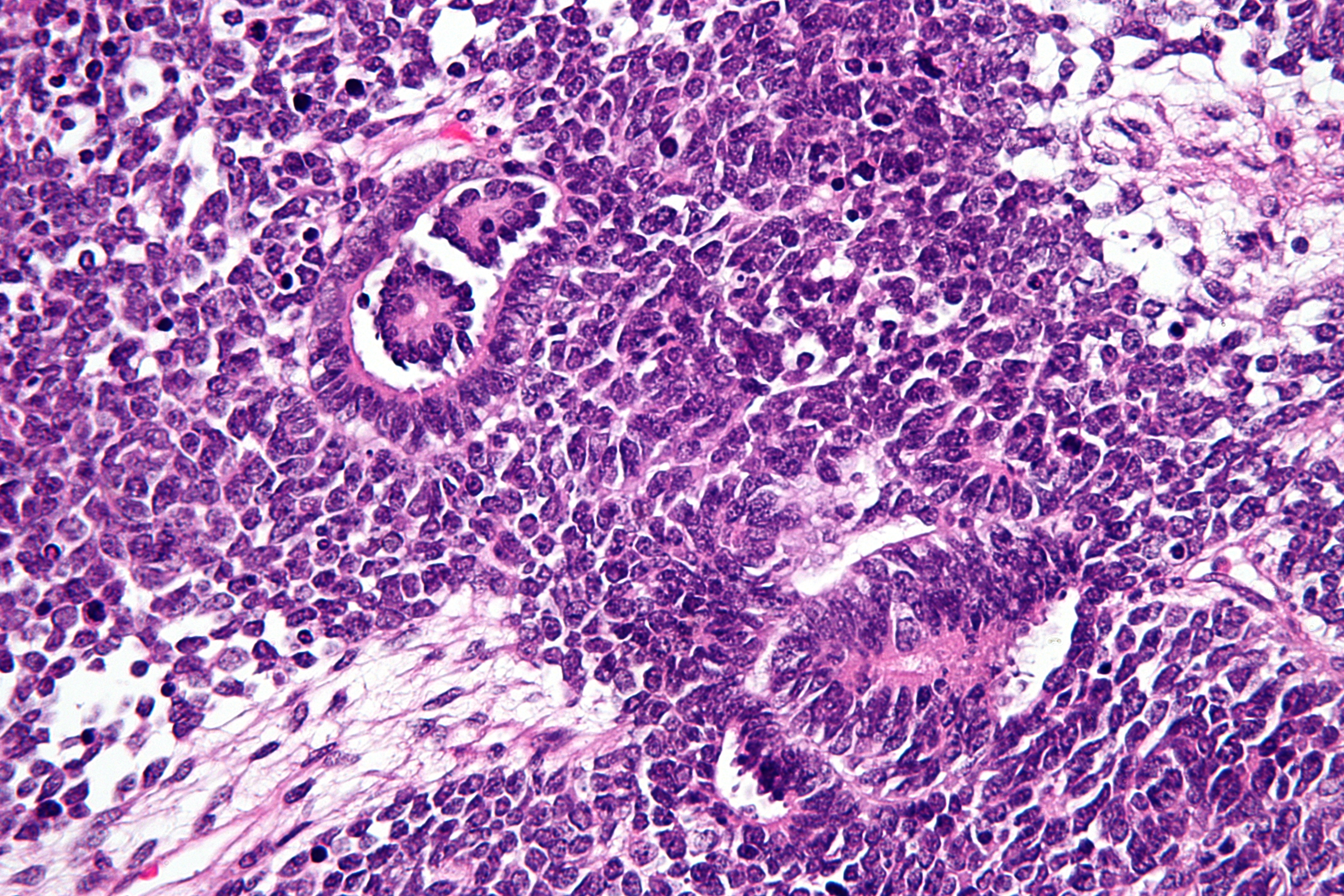 File:Wilms tumour - very high mag.jpg