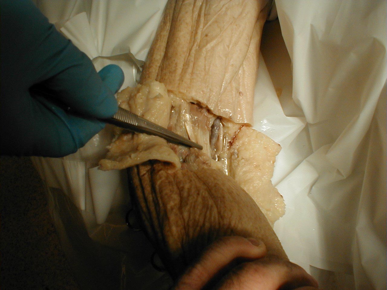 Biceps tendon: The tendon is grasped by forceps (gross dissection)