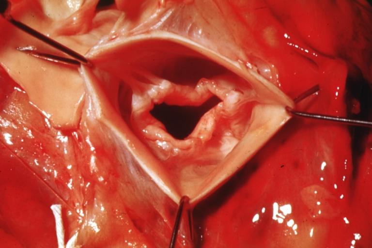 Aortic Stenosis, Bicuspid valve: Gross; good example of bicuspid valve