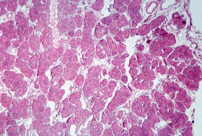 This low-power photomicrograph of pancreas shows increased interstitial connective tissue resulting in accentuation of the lobular pattern.