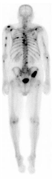 Bone metastases: prostate cancer Adapted from Wikipedia