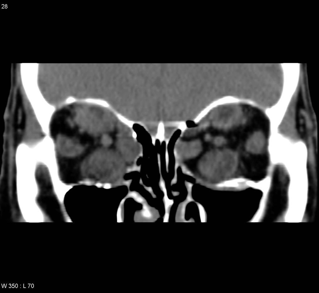 File:Thyroid-orbitopathy-severe-2.jpg