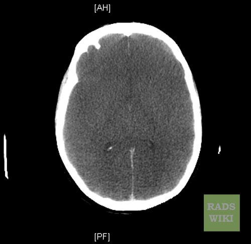 Anoxic-brain-injury-003.jpg