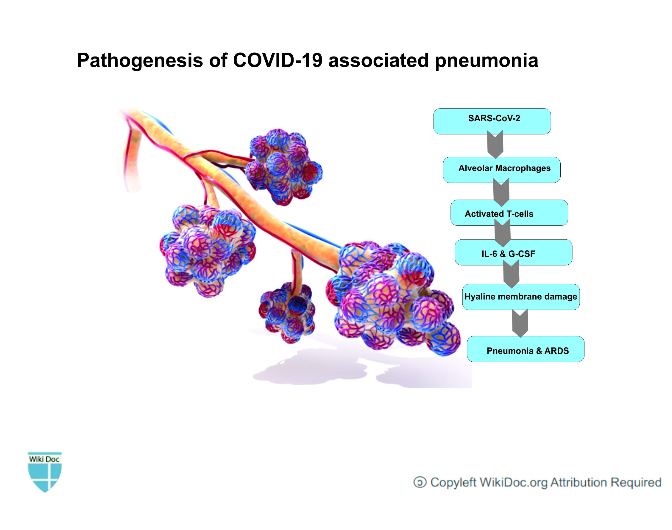 File:COVID-pneumonia-wikidoc.jpg