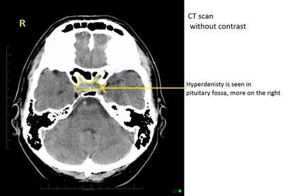 File:Pituitary-apoplexy marked.jpg