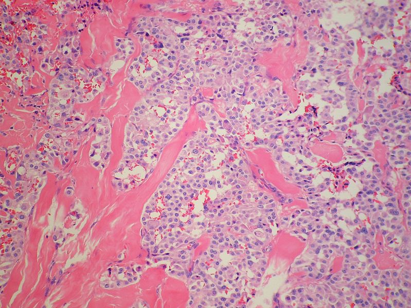 File:Thyroid MedullaryCarcinoma Amyloid MP4 PA.JPG