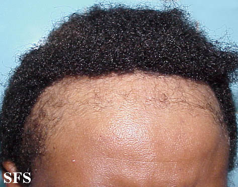 File:Traumatic alopecia02.jpg