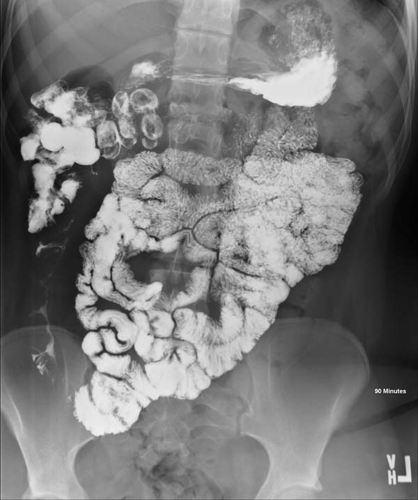 Abdominal x-ray of a patient with Crohn disease