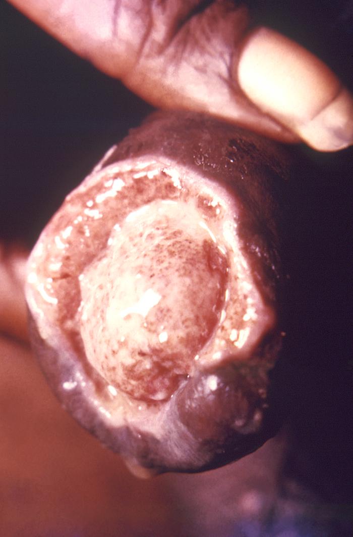 This image depicts the penis of a male with its foreskin retracted, revealing a suppurative lesion involving the glans and prepuce. From Public Health Image Library (PHIL). [4]