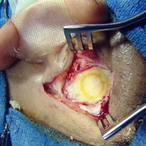 Surgical picture mastoid osteoma. The osteoma was removed with the drill and the mastoid surface smoothed down. Note the yellow discoloration ring at the site of the excised osteoma