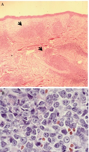 Hematoxylin & Eosin stain of skin lesion biopsy. Low power view of leukemic infiltrate corresponding to the raised plaque (A, black arrows) and high power view of the malignant cells in the skin infiltrate
