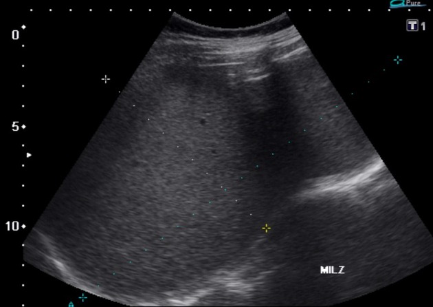 File:Splenic marginal zone lymphoma ultrasound longitudinal .jpeg