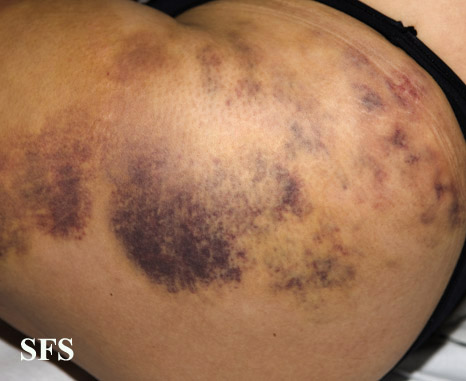 Painful bruising syndrome. With permission from from Dermatology Atlas.[5]