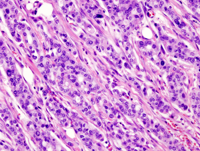 File:Pancreas adenocarcinoma - 1.jpg