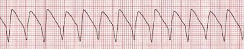 Pulseless ventricular tachycardia.jpg