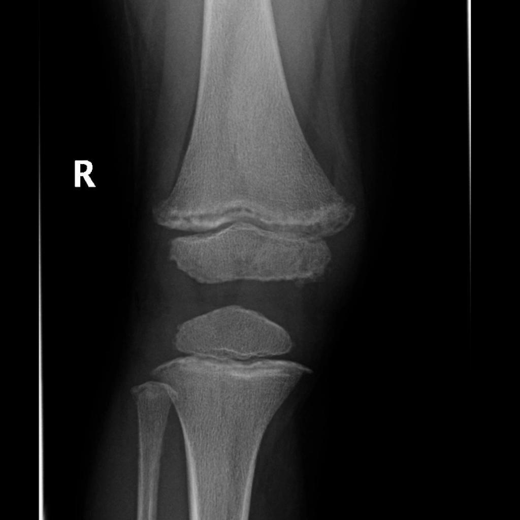 Frontal knee X ray[4]