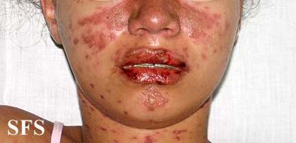 Lupus erythematosus-systemic. Adapted from Dermatology Atlas.[21]