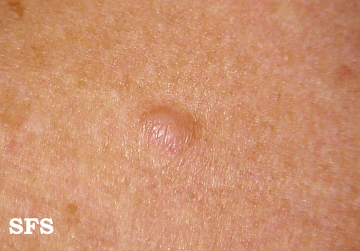 Neurofibroma. With permission from Dermatology Atlas.[2]