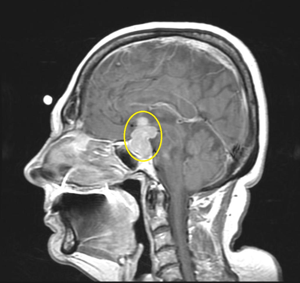 Pituitary adenoma - Case courtesy of A.Prof Frank Gaillard, <a href="https://radiopaedia.org/">Radiopaedia.org</a>. From the case <a href="https://radiopaedia.org/cases/16890">rID: 16890</a>