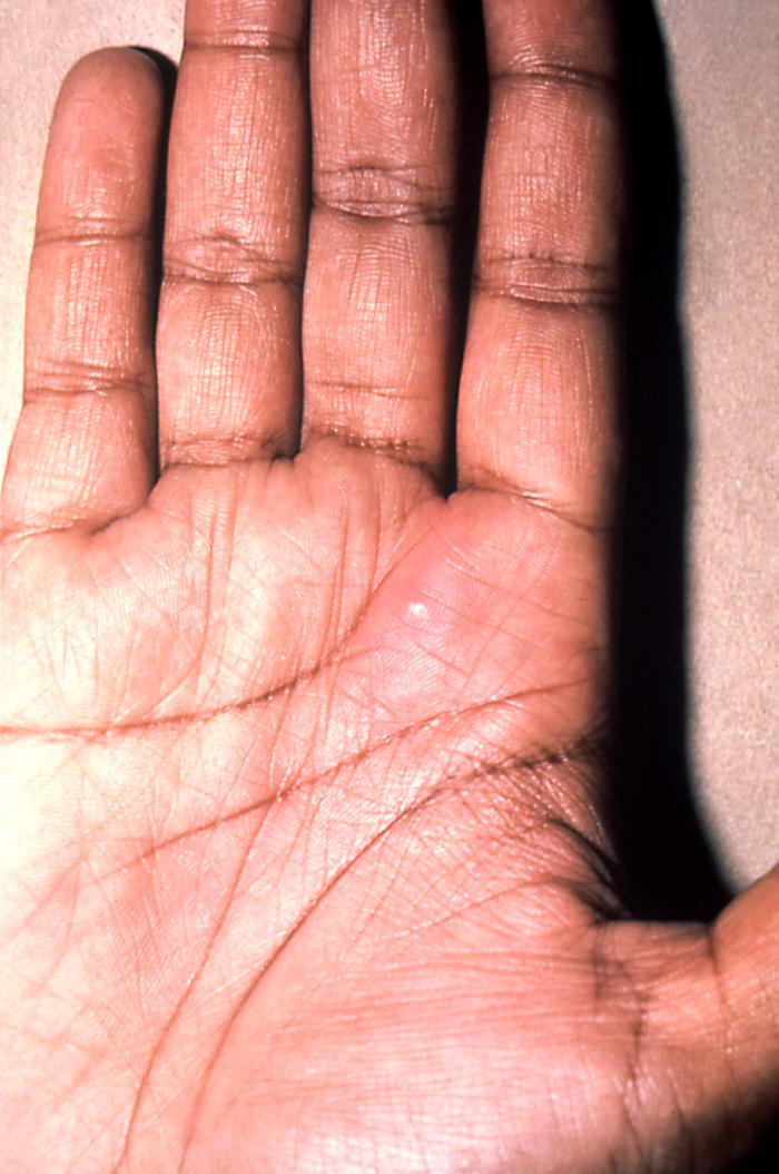 This patient presented with a cutaneous lesion on the palm of his right hand due to a N. gonorrhoeae infection.Though sexually transmitted, and involving the urogenital tract initially, a Neisseria gonorrhoeae bacterial infection can become disseminated systemically, manifesting itself as a cutaneous erythematous lesion anywhere on the body. Adapted from CDC