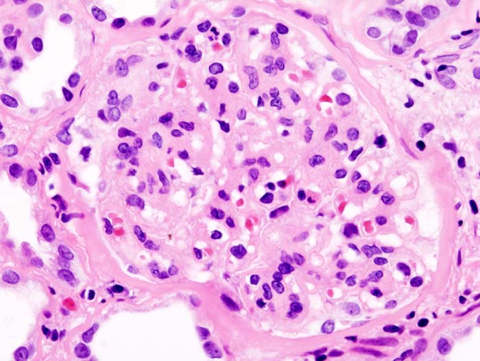 Histopathological image of diabetic glomerulosclerosis with nephrotic syndrome. Another glomerulus. H&E stain.