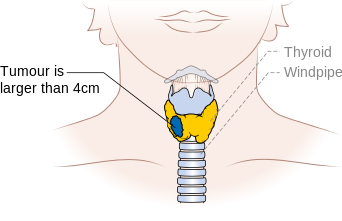 Diagram showing stage T3 thyroid cancer CRUK 265.png