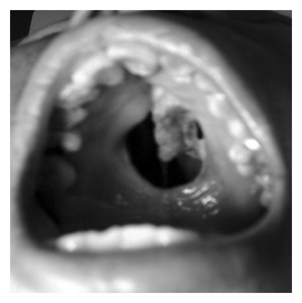 NK/T-cell lymphoma of the nasal type presenting with perforation of hard palate.[1]