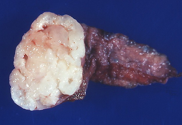 Gross pathology of pulmonary hamartoma.[12]