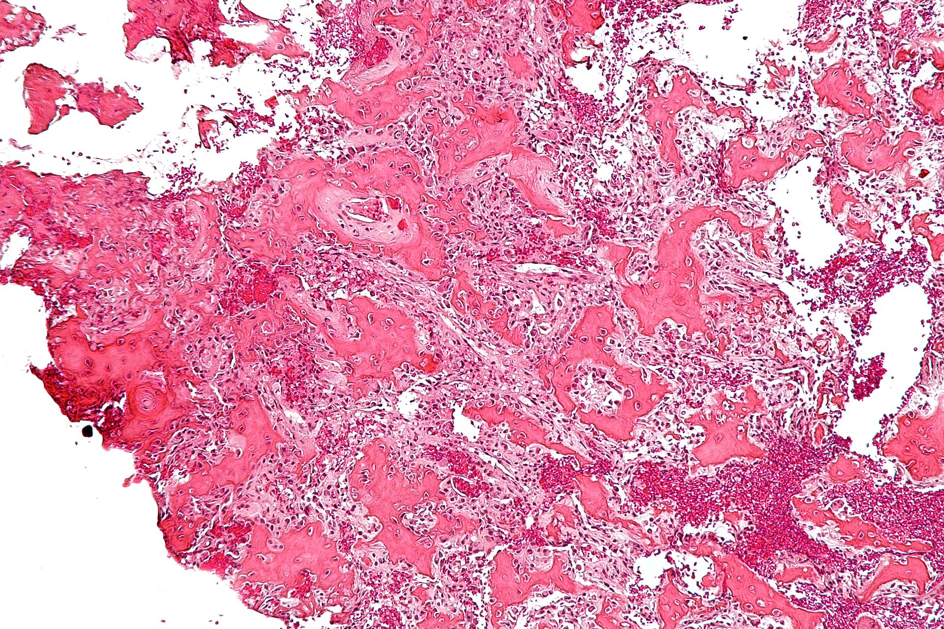 File:Osteoidosteoma micrograph.jpeg