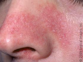 Seborrheic dermatitis showing erythema on face