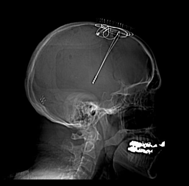 File:Subthalamic nucleus deep brain stimulators 001.jpg