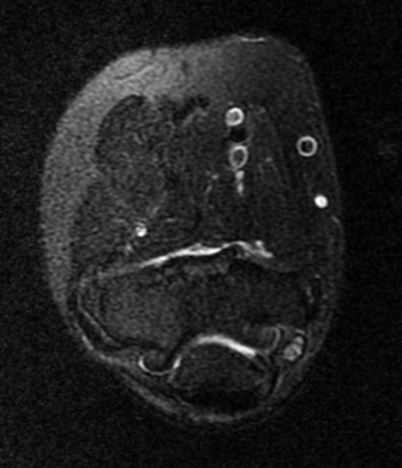 File:Ulnar nerve entrapment MRI 002.jpg