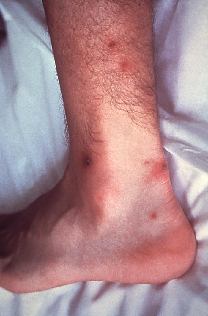 His patient presented with cutaneous lesions on his left ankle and calf due to a disseminated N. gonorrhoeaeinfection.Though sexually transmitted, and involving the urogenital tract initially, a Neisseria gonorrhoeae bacterial infection can become disseminated systemically, manifesting itself as a cutaneous erythematous lesion anywhere on the body.
