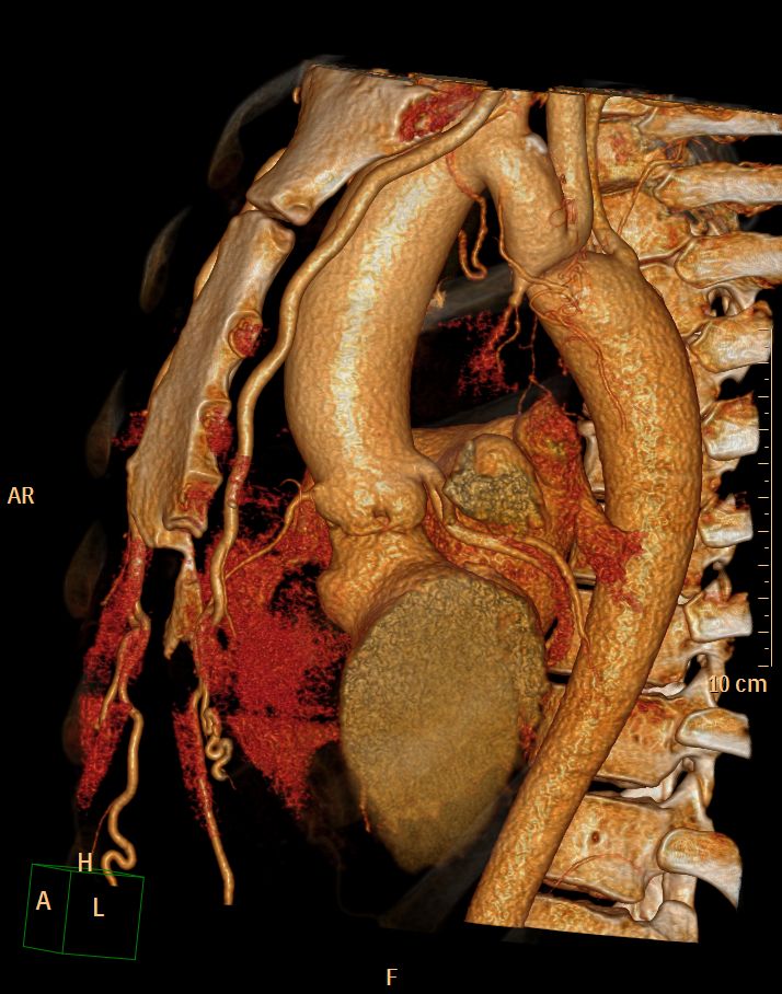 File:Coarctation-of-the-aorta-CT-005.jpg