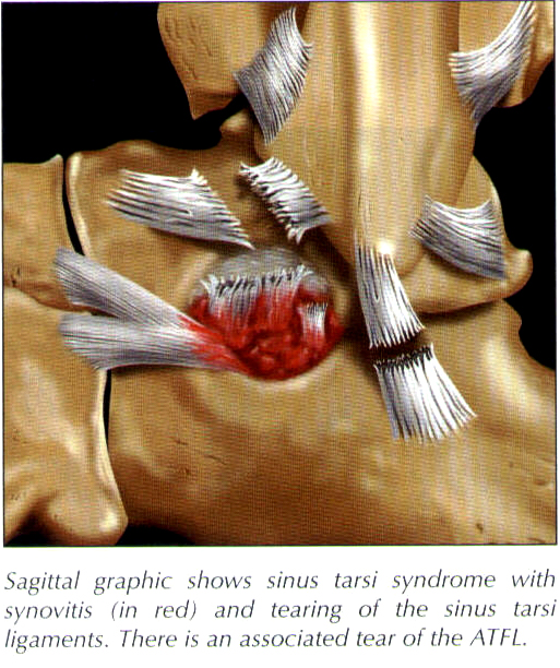 File:Fibulo-talo ligament strain.jpg