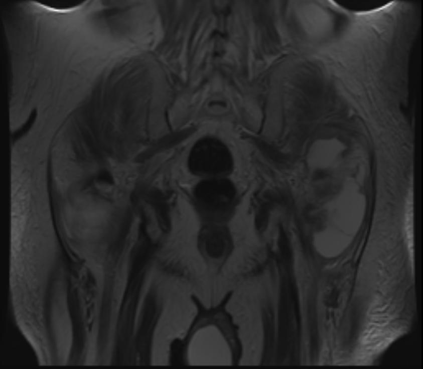 File:Greater trochanter bursitis MRI 001.jpg