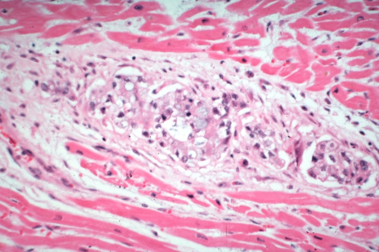 HEART: Metastatic Carcinoma: Micro med mag H&E, a small metastasis in myocardium, stomach is primary