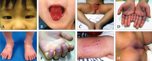 (A) Bilateral, non-exudative conjunctival injection with perilimbal sparing. (B) Strawberry tongue and bright red, swollen lips with vertical cracking and bleeding. (C) Erythematous rash involving perineum. (D) Erythema of the palms, which is often accompanied by painful, brawny edema of the dorsae of the hands. (E) Erythema of the soles, and swelling dorsa of the feet. (F) Desquamation of the fingers. (G) Erythema and induration at the site of a previous vaccination with Bacille Calmette-Gurin (BCG). (H) Perianal erythematous desquamation