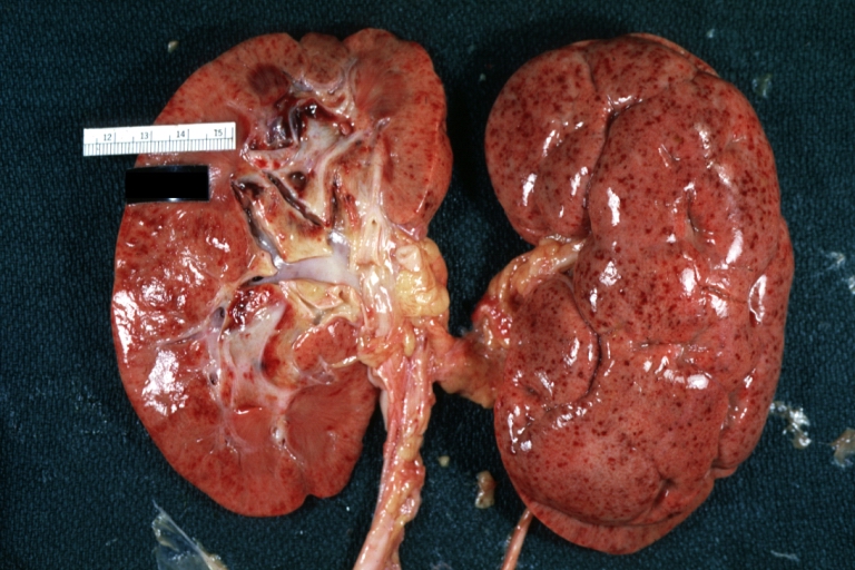 Kidney: Petechiae: Gross natural color, an excellent example of flea bitten kidney case had necrotizing vasculitis
