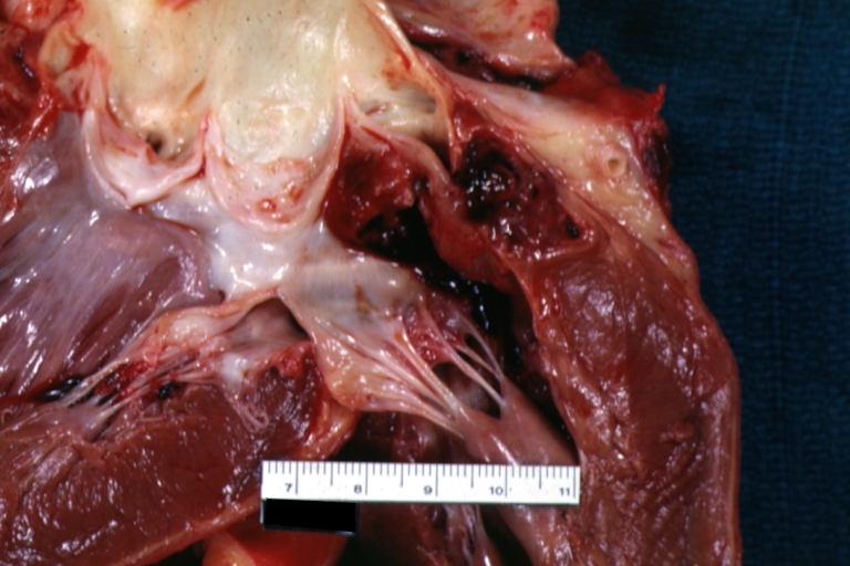 Ruptured Sinus of Valsalva Aneurysm: Gross; natural color close-up of aneurysm in aortic valve.