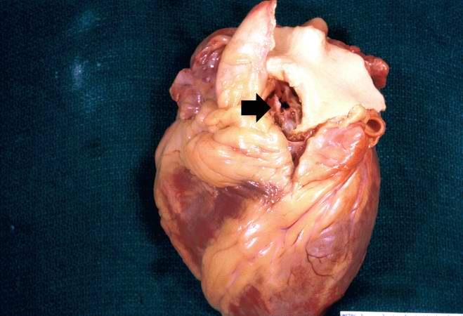 Metastatic calcification is only one of two forms of pathologic calcification. Unlike metastatic calcification, dystrophic calcification does not require an increase in serum calcium levels. This is a gross specimen of a heart with dystrophic calcification of the aortic valve (arrow).