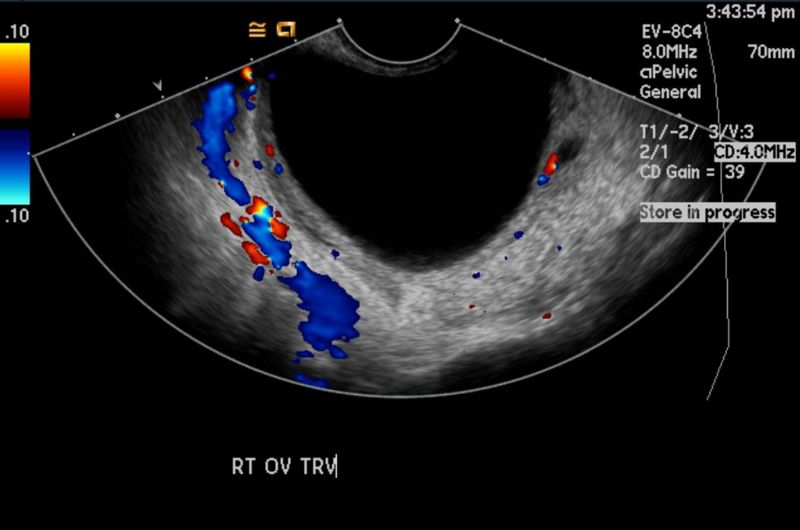 Ovarian cyst 105.jpg