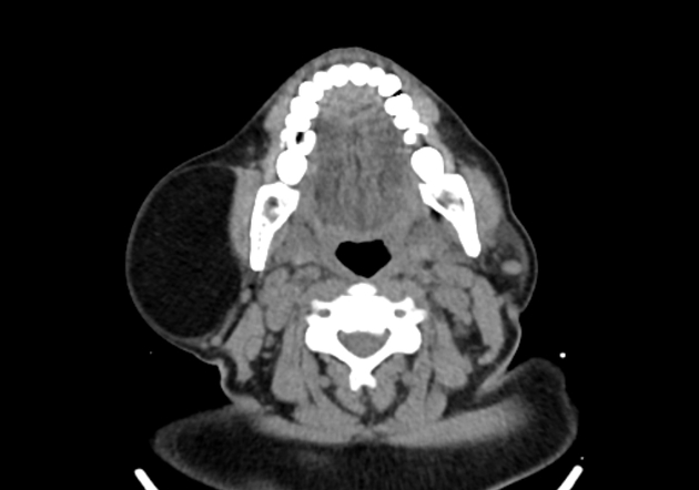 Axial non contrast CT parotid lipoma[3]